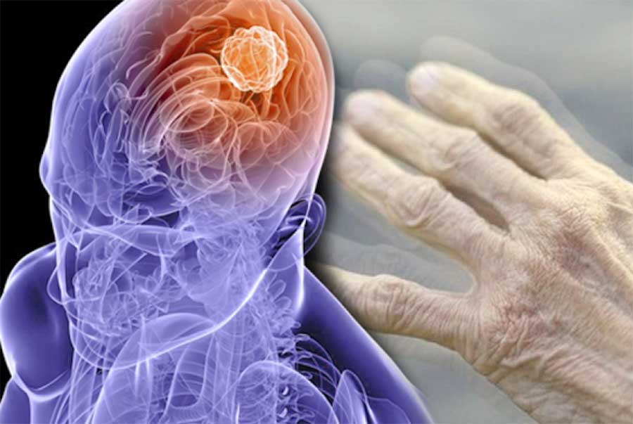 Parkinson hastalığı